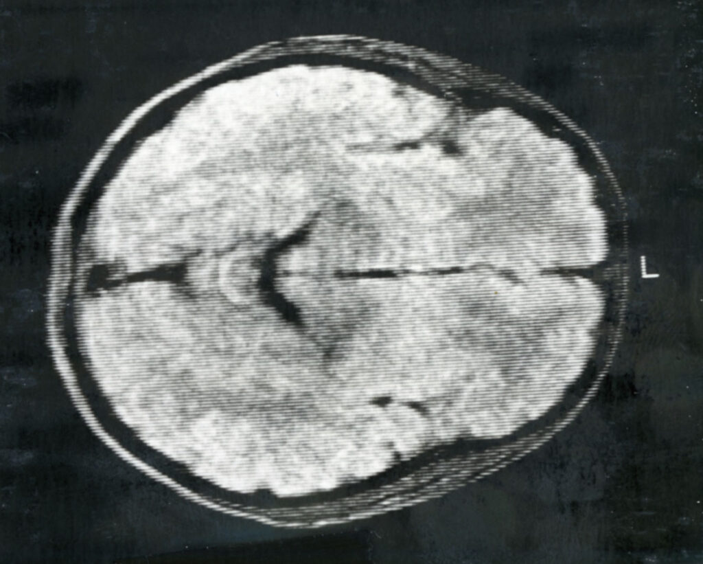 MRI head scan from a patient logbook, 1986, MSS 2002-08. The image is from a Polaroid photograph of a computer screen.