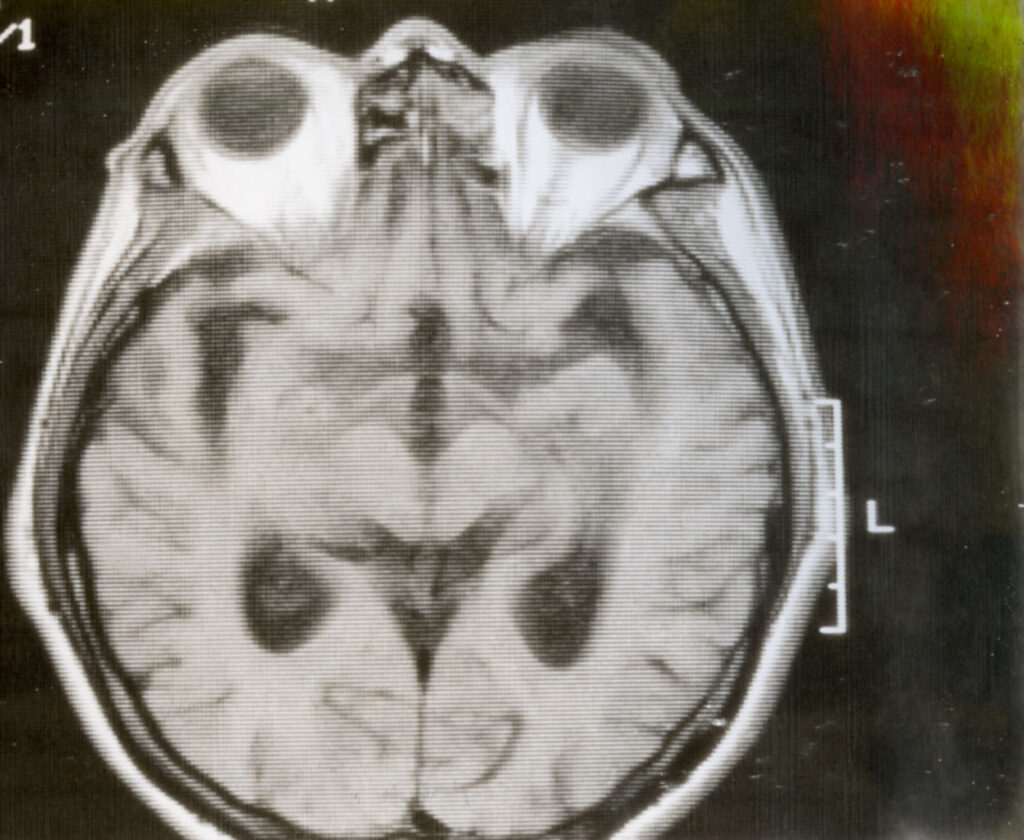 MRI head scan from a patient logbook, 1988, MSS 2002-08. The image is from a Polaroid photograph of a computer screen.