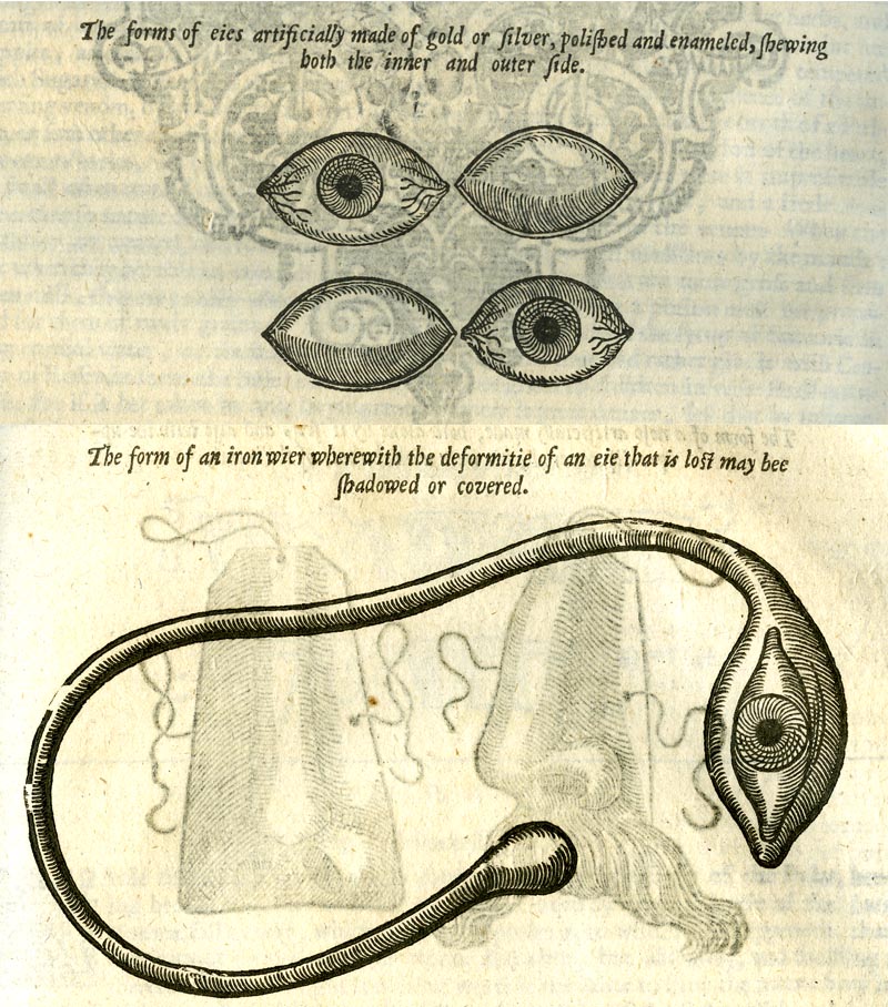Illustrations for Hypoblephara (top) and Ekblephara from a book by Ambroise Paré, "The workes of that famous chirurgion Ambrose Parey...," 1649.The digital copy of othis book is accessible online through the Medical Heritage Library: https://archive.org/details/workesofthatfamo00par.