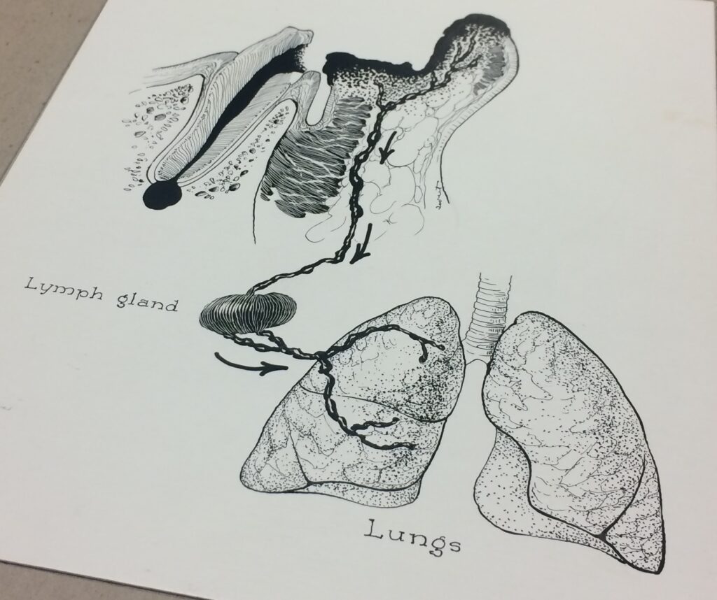 A pen and ink illustration of the lungs and a lymph gland from the Ralph Sweet Collection of Medical Illustrations